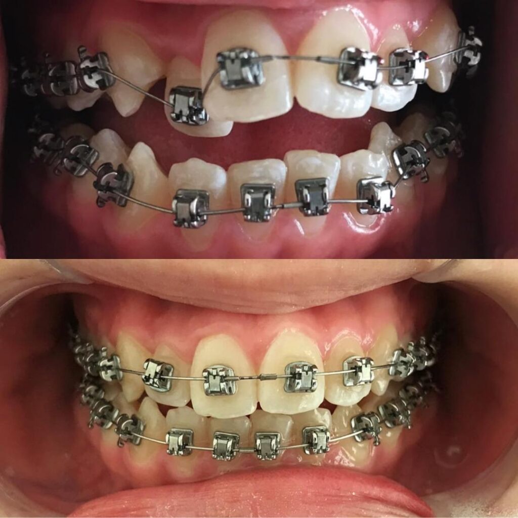 Trindade Odontologia - Aparelho Transparente: Tratamentos.